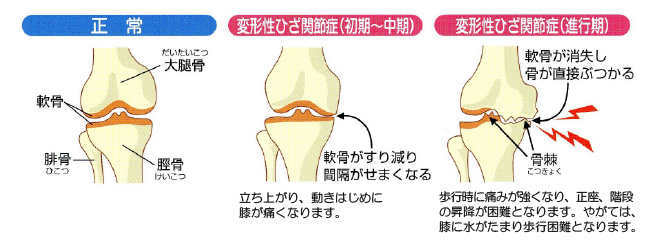 変形性関節症　膝関節